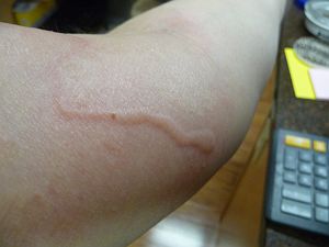 Allergic Reaction To Mosquito Bites - The Secret To Stopping The Itch